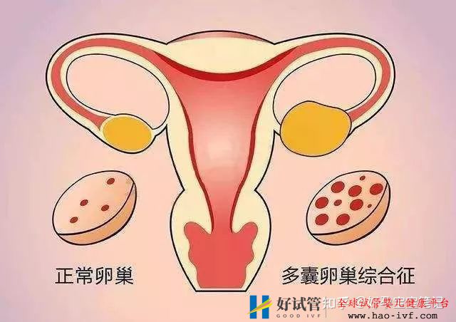 多囊多年至不孕,试管移植二次成功!经验分享!(图1) 多囊多年至不孕,试管移植二次成功!经验分享!(图1)