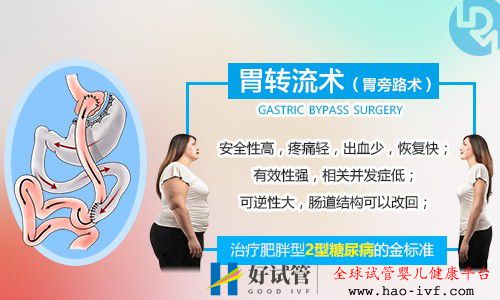 胃转流手术要满足什么条件才可以做?国内有胃转流手术吗?(图2) 胃转流手术要满足什么条件才可以做?国内有胃转流手术吗?(图2)