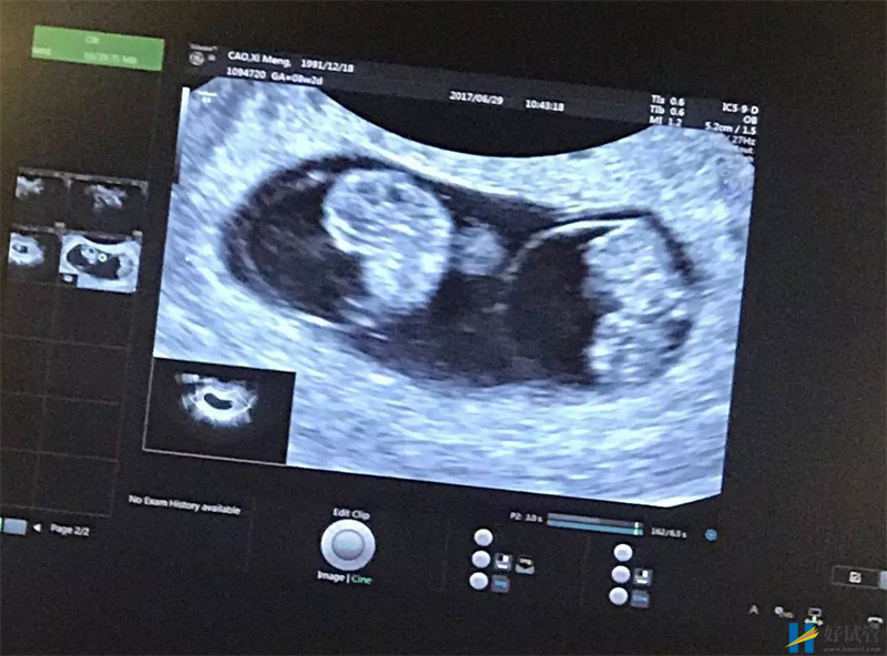 双胞胎与单胎症状大有不同,孕妈教你看懂这5个暗示(图2) 双胞胎B超图