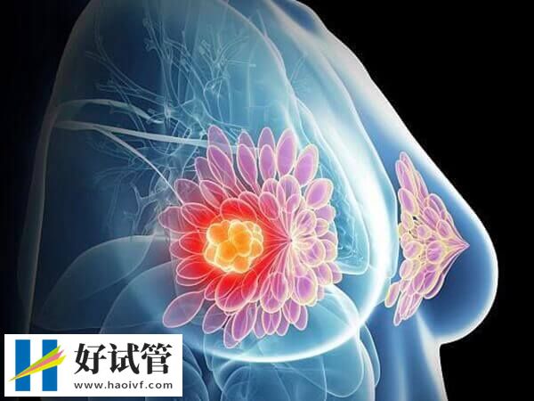 促排会不会导致乳腺癌(图1)