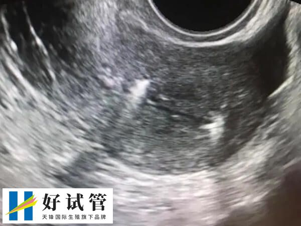 宫腔环境会影响胚胎移植的成功率