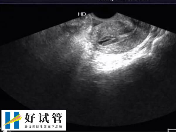 试管前的全面检查有助提高试管成功率