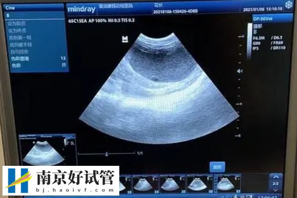 取卵后的第三天还是第七天是腹水高峰期呢？